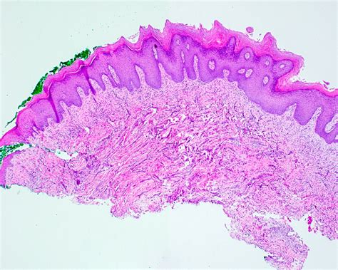 Pathology Outlines Proliferative Verrucous Leukoplakia Pvl