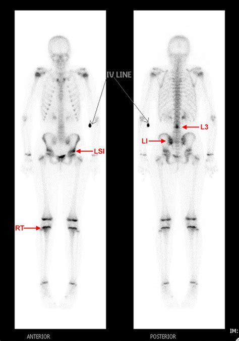 Paediatric Chronic Recurrent Multifocal Osteomyelitis Bmj Case Reports