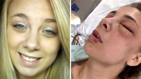 Us Woman Receives Prosthetic Eyeballs After Gouging Out Eyes While On