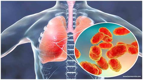 Pneumonie Bactérienne Symptômes Et Traitement Fmedic