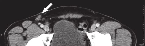 Detailed Ct Image Of The Right Groin A 65 Yr Old Penile Cancer Patient Download Scientific