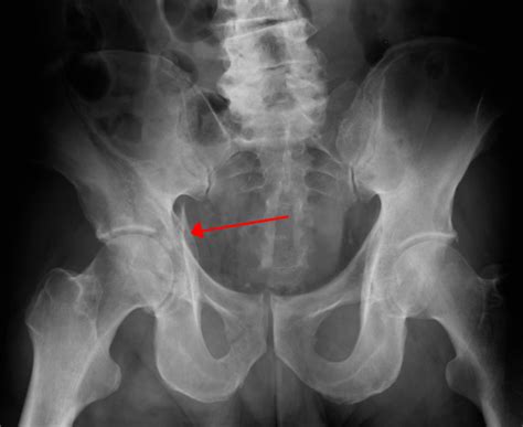 Acetabular pelvic fractures - WikEM