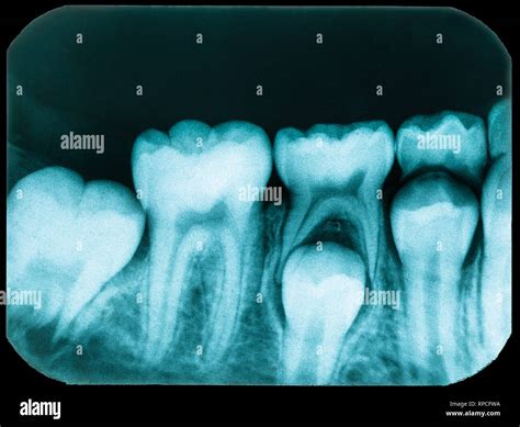 Old Dental X Ray With Teeth In Bad Condition Stock Photo Alamy