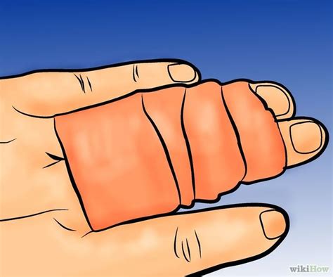 how to treat a broken finger 1 step with pictures wikihow broken finger picture finger