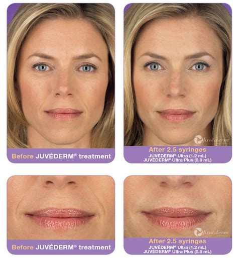 The lip enhancement process involves the use of a hyaluron pen to deliver hyaluronic acid into the lips, restoring some of its plump. The Woodlands Plastic Surgeon® : Dermal Filler Injection ...