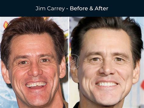 Celebrity Dental Implants And Veneers Before And After Photos