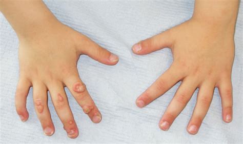 Warts On Children How To Get Rid Of Them Safely And Effectively Med