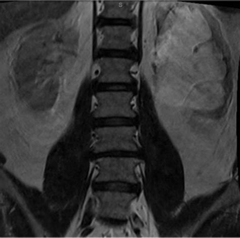 Rare Extraspinal Cause Of Acute Lumbar Radiculopathy Bmj Case Reports