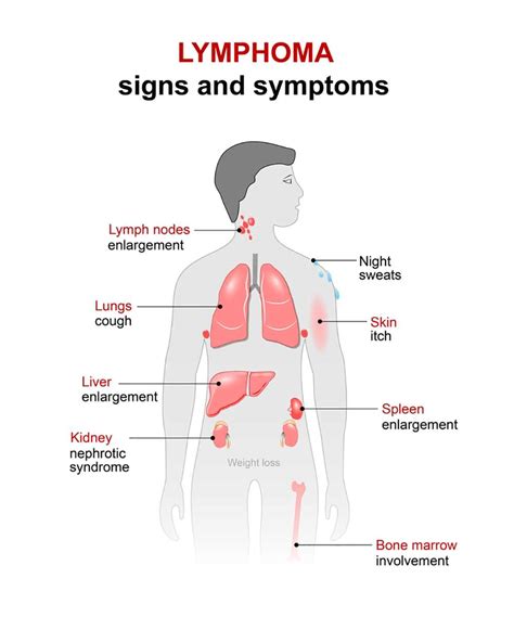 Lymphoma Symptoms 9 Signs Of Hodgkins And Non Hodgkins Lymphoma