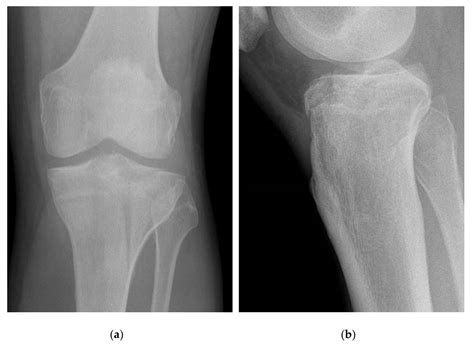 Tibial Condyle Fracture