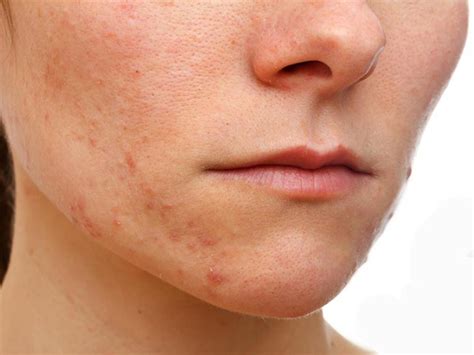 Facial Eczema Treatments To Get Rid Of Eczema On Face
