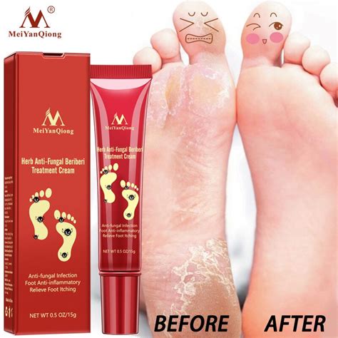 Herbal Anti Fungal Relieve Beriberi Foot Cream Treatment Itching