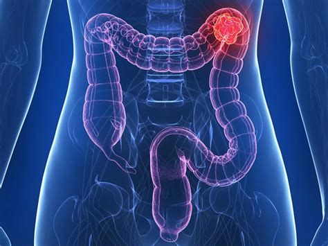 Simply put, the colon is used to provide a pause before introducing related information, while the semicolon is just a break in a sentence that is stronger than a comma but not as final as a full stop. Bowel Cancer Awareness Month - myDr.com.au