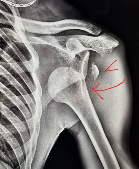 Shoulder Xray Anterior Dislocation Of Humeral Head Arrow With An