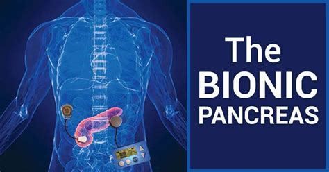 The Progress Toward A Bionic Pancreas For Type 1 Diabetes