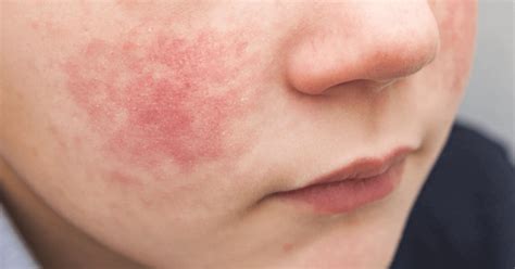 Fifth Disease Causes Symptoms And Treatment Apollo Hospital Blog