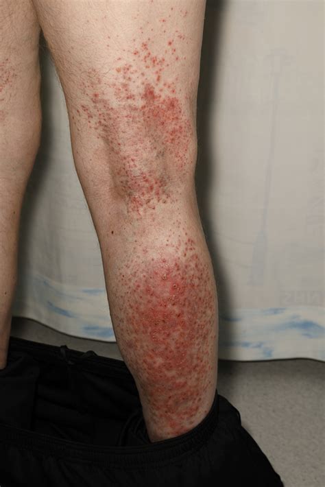 Acute Onset Rash In A Limited Distribution The Bmj