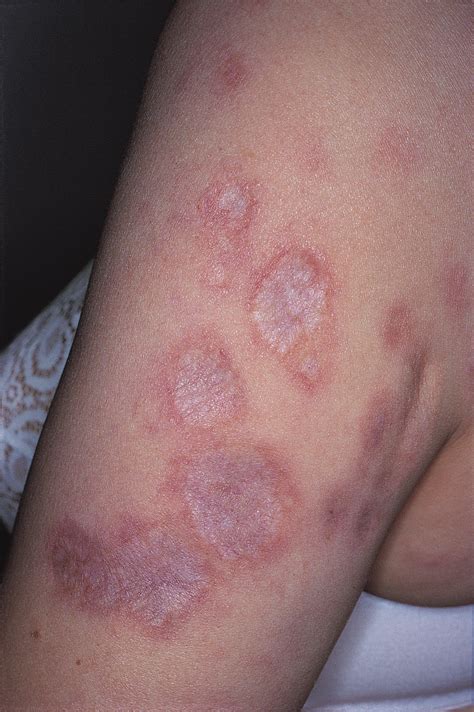 Cutaneous Sarcoidosis Successfully Treated With Low Doses Of