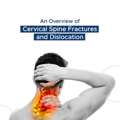 An Overview Of Cervical Spine Fractures And Dislocation
