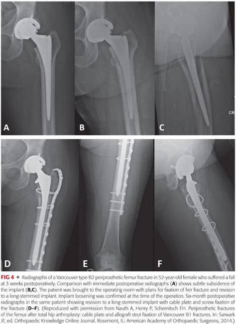 Of Periprosthetic Fractures About Below Total Hip Arthroplasty