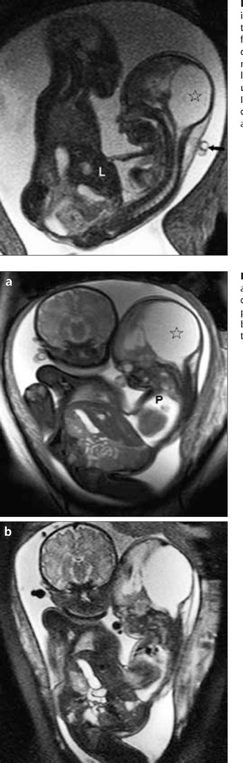 figure 2 from mri of omphalopagus conjoined twins with a dandy walker malformation prenatal