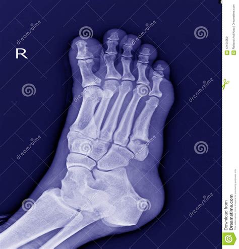 X Ray Foot 5th Metatarsal Base Fracture Stock Image Image Of