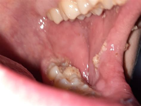 Remedies to remineralize teeth will help get rid of white spots permanently! How Much Does It Cost To Have Braces Removed