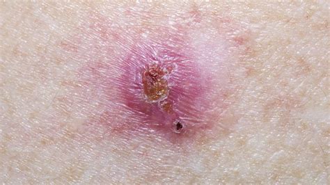 What Does Skin Cancer Really Look Like Cancer Sharecare