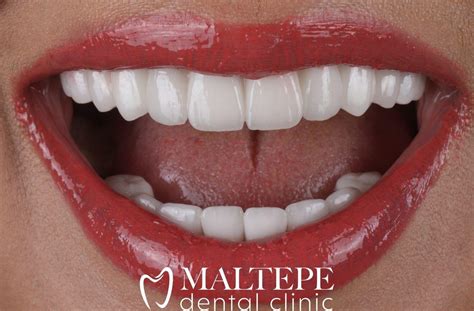 Everything Youve Ever Wanted To Know About Hollywood Smile Maltepe Dental Clinic