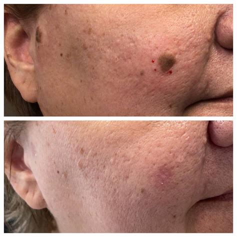 Seborrheic Keratosis Removal Before And After St Louis Dermatology And Cosmetic Surgery