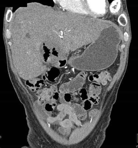 Ulcerating Carcinoma Of The Gastric Antrum With Liver Metastases