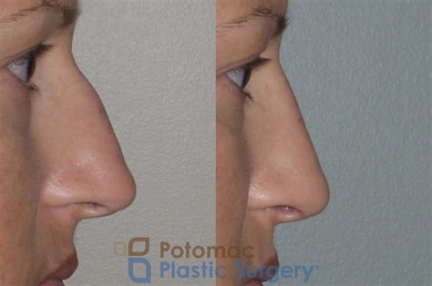 Septorhinoplasty With Nasal Valve Repair To Improve Both The Function