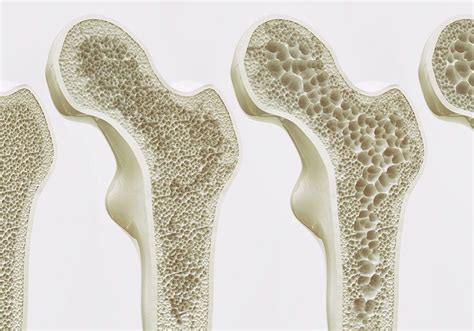 COVID-19 and fragility fractures - APFFA