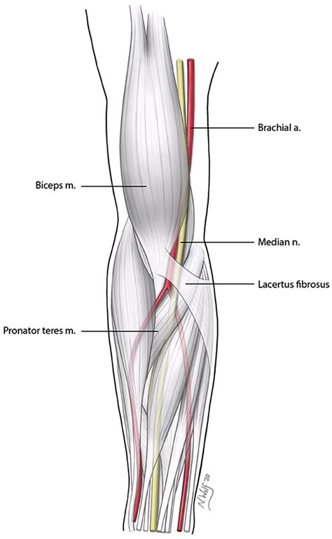 Proximal Median Nerve Compression Pronator Syndrome Journal Of Hand