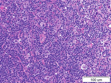 Histopathology Slide Hodgkins Lymphoma Of Nodular Subtype Download