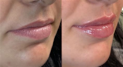 Lip Flip The New Trend In Anti Wrinkle Injections Advanced Cosmetic
