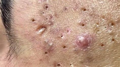 Acne Treatment