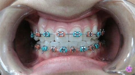 The Best 15 Good 2 Color Combinations For Braces Factstreetviral