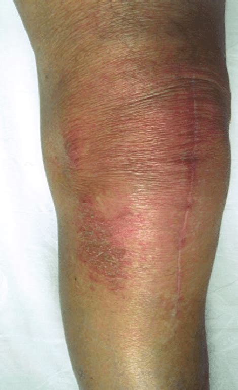 Patient With A Painful Knee Arthroplasty And Local Eczema Download