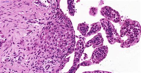 Pathology Outlines Tenosynovial Giant Cell Tumor