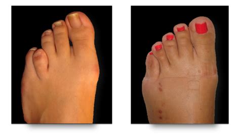 Brachymetatarsia Brachymet Short Toe — Foot Ankle Surgery