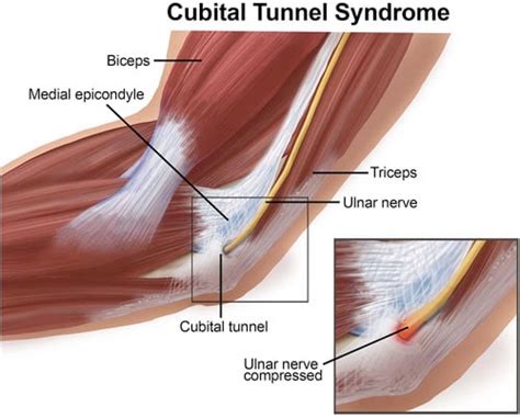 Cubital Tunnel Syndrome Nashville Neurosurgery Associates