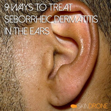 Seborrheic Dermatitis Ear And Scalp Javsystema
