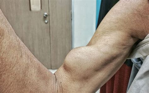 Distal Biceps Tendon Tear Causes Symptoms And Treatment