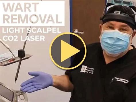 Laser Wart Removal Video