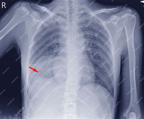 Premium Photo Chest X Ray Showing Mass Rt Lower Lung Field Likely