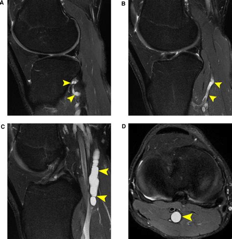 Imaging Of The Nerves Of The Knee Region European Journal Of Radiology