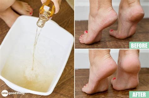 This Listerine And Vinegar Foot Soak Is Magic For Dry Heels Listerine
