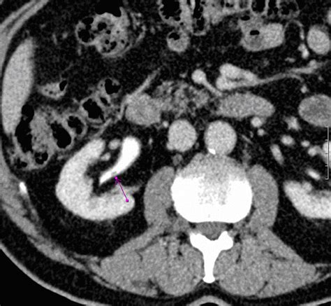 Multiple Transitional Cell Carcinomas In The Pelvis And Ureter Eurorad
