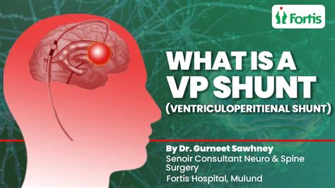 Ventriculoperitoneal Shunt What Is A Vp Shunt Used For Is Vp Shunt